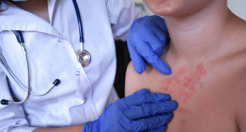 Mpox, l'OMS aggiorna il monitoraggio: la sorveglianza resta alta